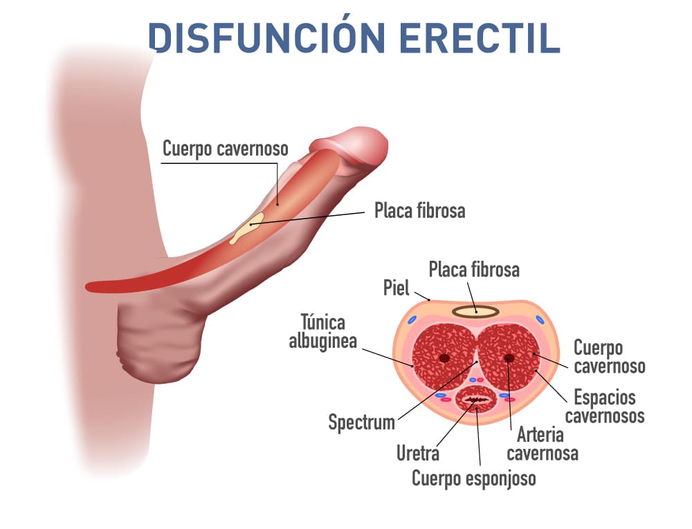Disfunción Erectil Dr Carlos Velasquez Urologo en Medellin (1)