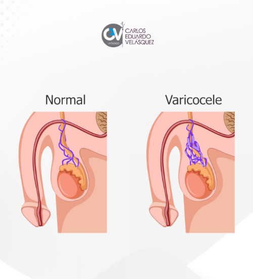 Cuáles son los grados de varicocele - Tratamiento para la Varicocele - Dr Carlos Velasquez Urólogo en Medellin