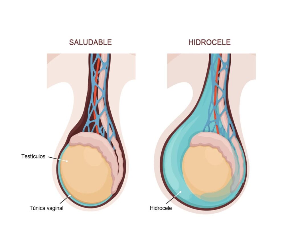 Hidrocele medellin - carlos velasquez urologo