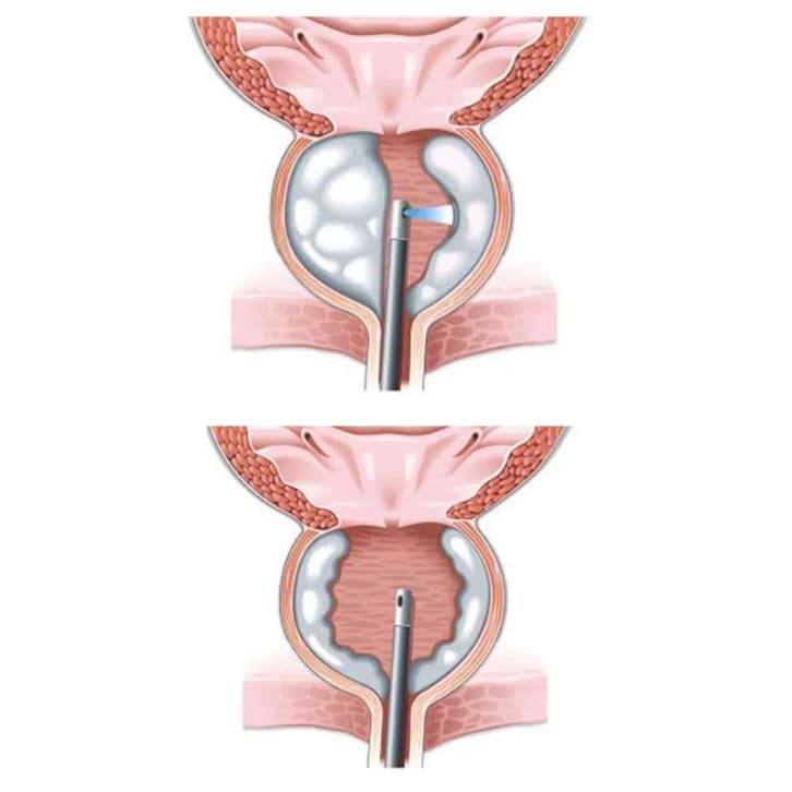 Prostatic Hyperplasia- Dr. Carlos Velásquez- Urologist in Medellín