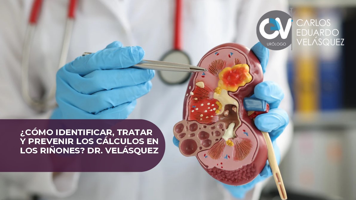 Cálculos en los riñones- Dr. Carlos Velásquez- Urólogo en Medellín
