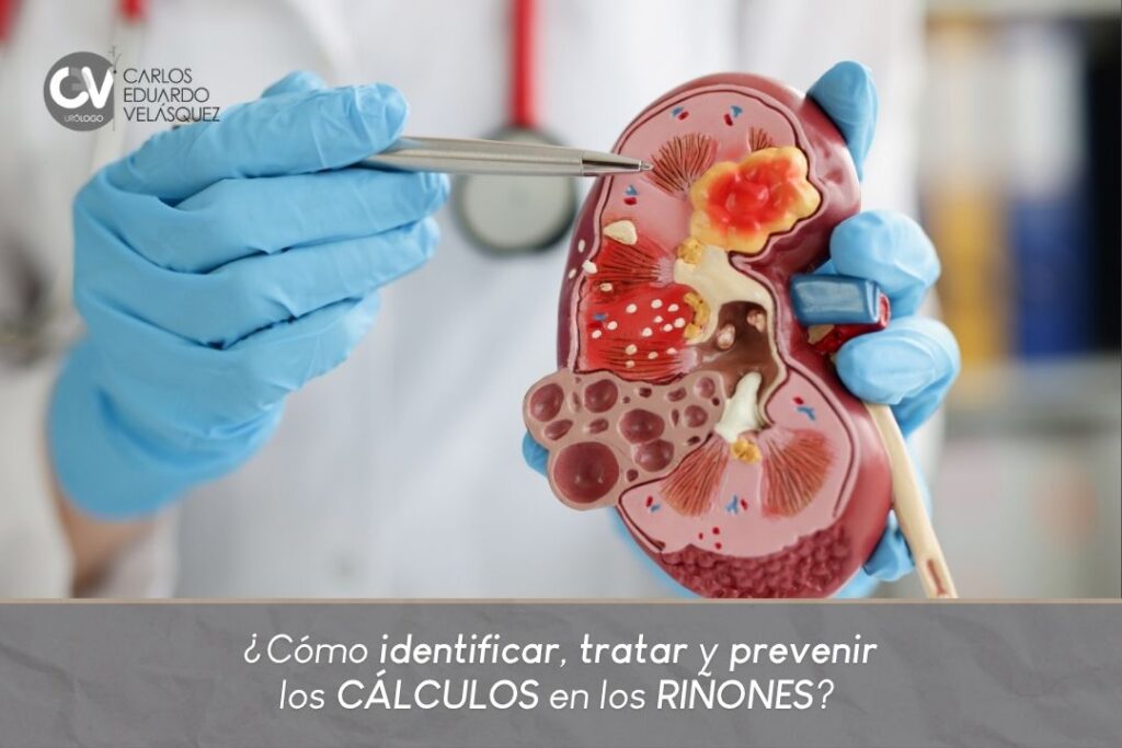 Cálculos en los riñones- Dr. Carlos Velásquez- Urólogo en Medellín