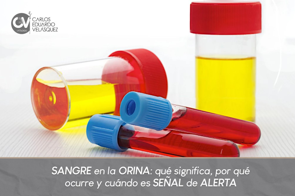 Sangre en la orina-Dr. Carlos Velásquez