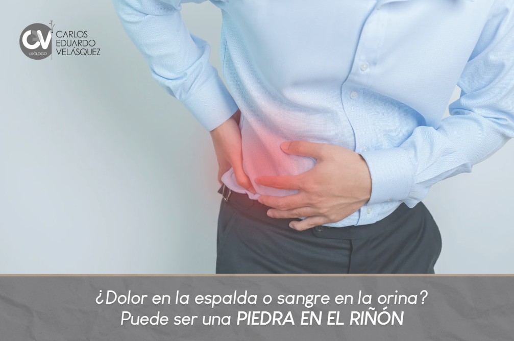 Piedra en el riñón- Dr. Carlos Velásquez